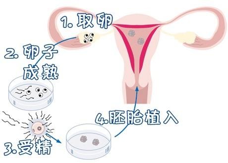第三代试管婴儿